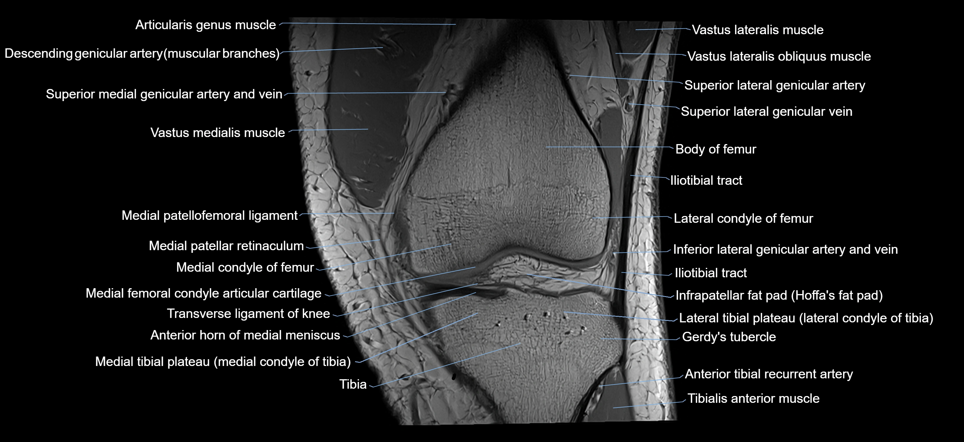 MRI knee coronal cross sectional anatomy labelled 3T radiology  image-04001-00014.webp